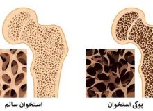 پوکی استخوان چه زمان در زنان شروع می‌شود