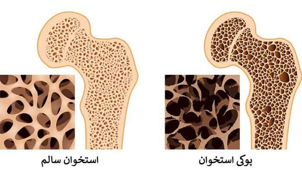 پوکی استخوان چه زمان در زنان شروع می‌شود